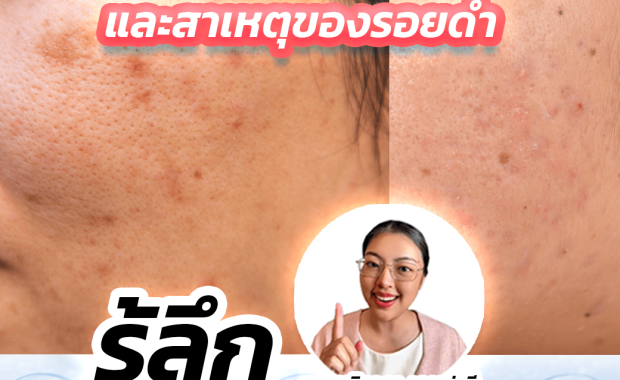 ชนิดของรอยดำและสาเหตุของรอยดำ – รู้ลึกก่อนรักษาอย่างถูกวิธี