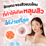 ลักษณะของสิวแบบไหน ที่ทำให้เกิดหลุมสิวได้ง่ายที่สุด