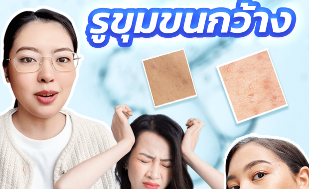 สาเหตุของรูขุมขนกว้าง รูขุมขนกว้างสามารถเกิดได้จากหลายปัจจัย ซึ่งอาจเกิดจากพฤติกรรมการดูแลผิว หรือปัจจัยที่ควบคุมไม่ได้ เช่น กรรมพันธุ์