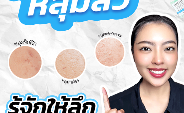 ประเภทของหลุมสิว – รู้จักให้ลึกก่อนเลือกวิธีรักษา