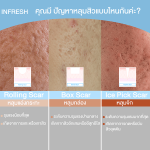 ประเภทของหลุมสิว – รู้จักให้ลึก ก่อนเลือกวิธีรักษาให้ตรงจุด