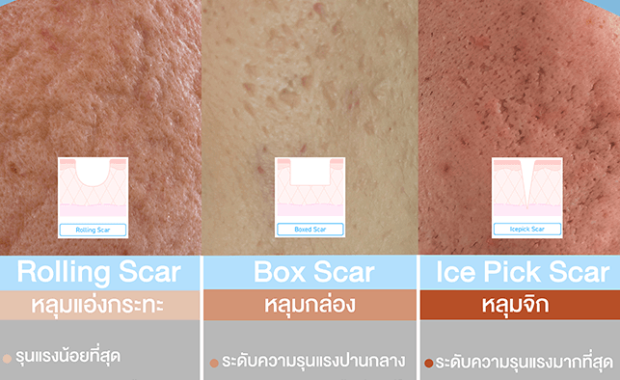 ประเภทของหลุมสิว – รู้จักให้ลึก ก่อนเลือกวิธีรักษาให้ตรงจุด